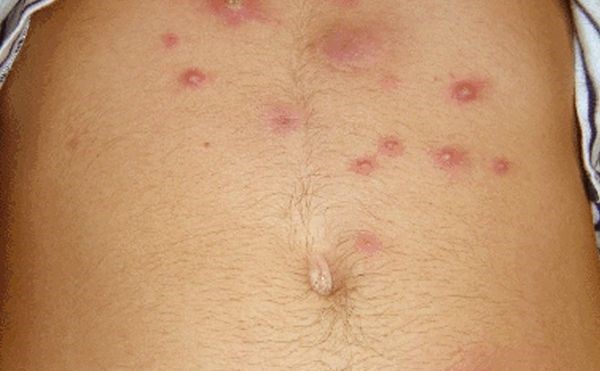 Геморрагическая сыпь при орви Геморрагическая сыпь при орви