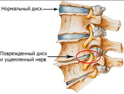 болит шея не повернуть голову после сна