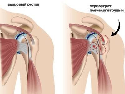 болит спина и шея и отдает в руку