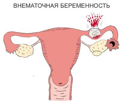 В первые дни цикла болит спина
