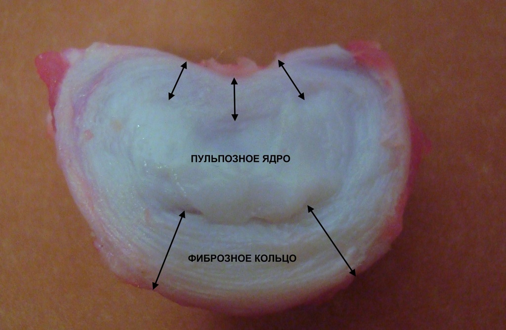 Анатомия нормального межпозвонкового диска
