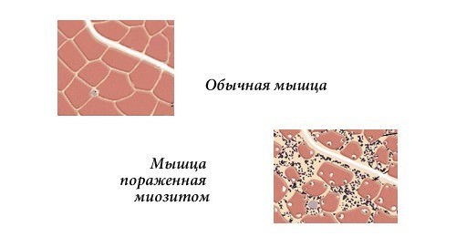 болят мышцы грудины и спины