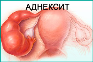 Аднексит Воспаление яичников
