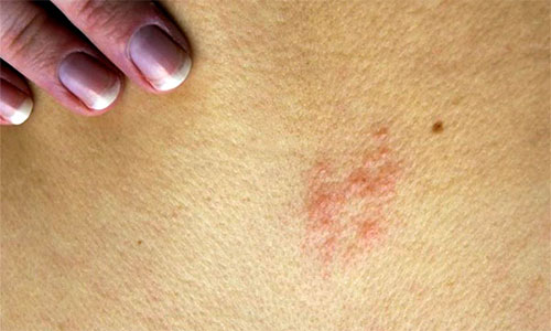 Герпес на спине - сыпь