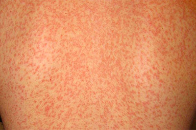 Сыпь при инфекционном мононуклеозе