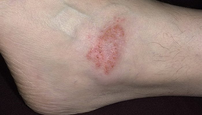 герпес на ноге