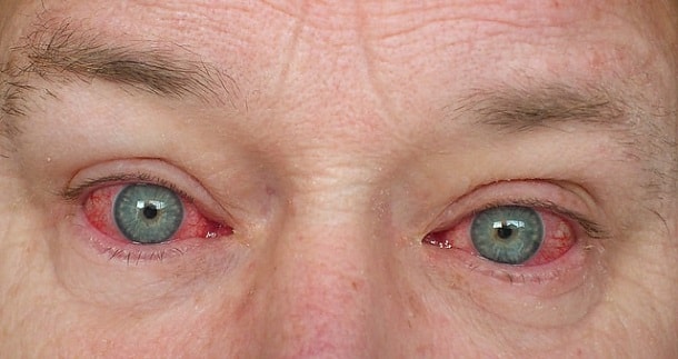 важный симптом режет в глазах