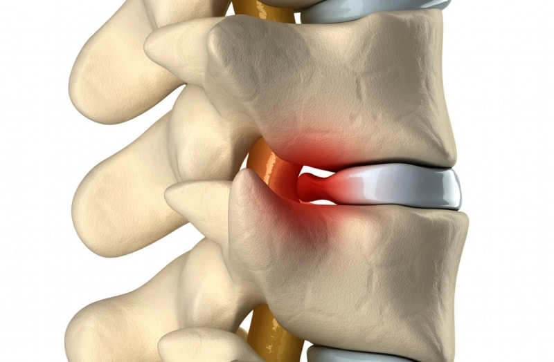 Межпозвоночная грыжа