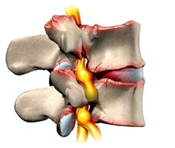 болят ребра со спины тяжело дышать