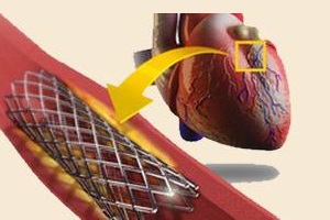 Стентирование сосудов сердца Стентирование