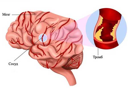 тромб в головном мозге