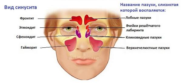 Виды синусита Виды синусита
