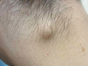 Воспаление лимфоузлов на затылке