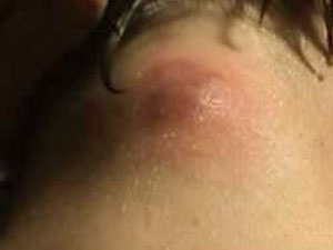 Воспаление затылочных лимфоузлов